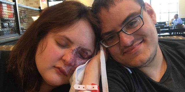 A photo of Crystal and her fiance, as Crystal leans on him while holding an icepack to her face.
