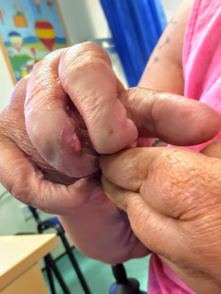 a woman's fingers bent and scarred due to arthritis