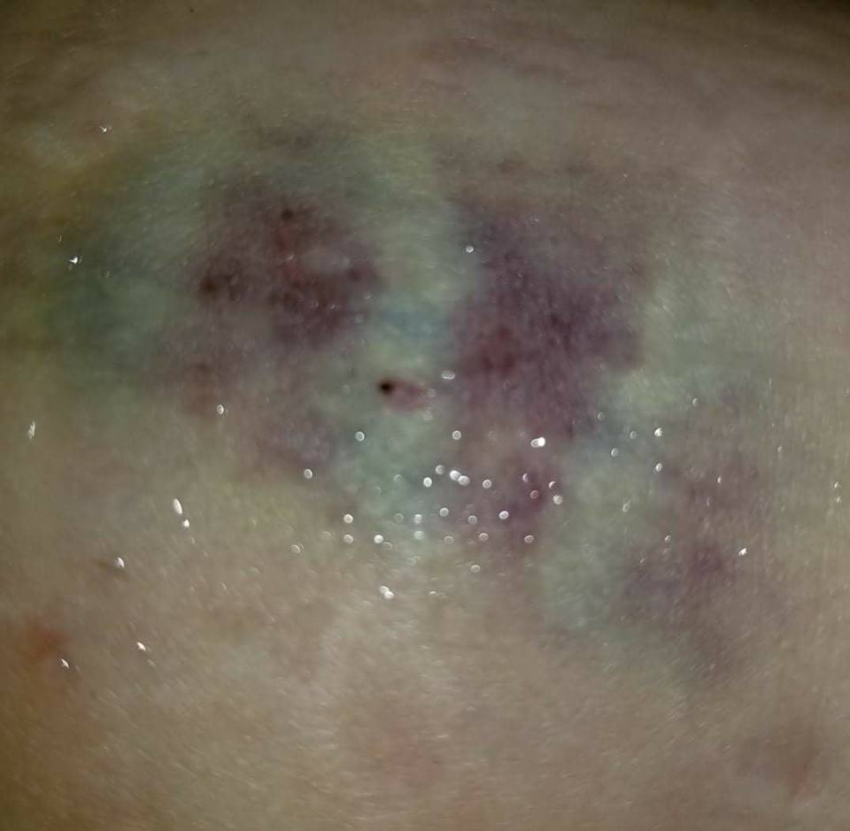 bruised area on woman's skin