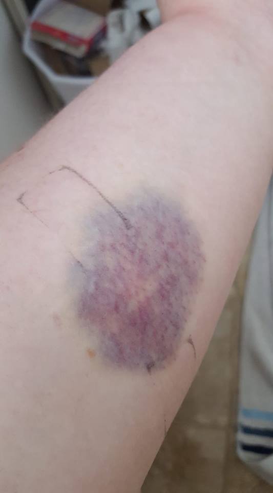 large bruise on a woman's skin