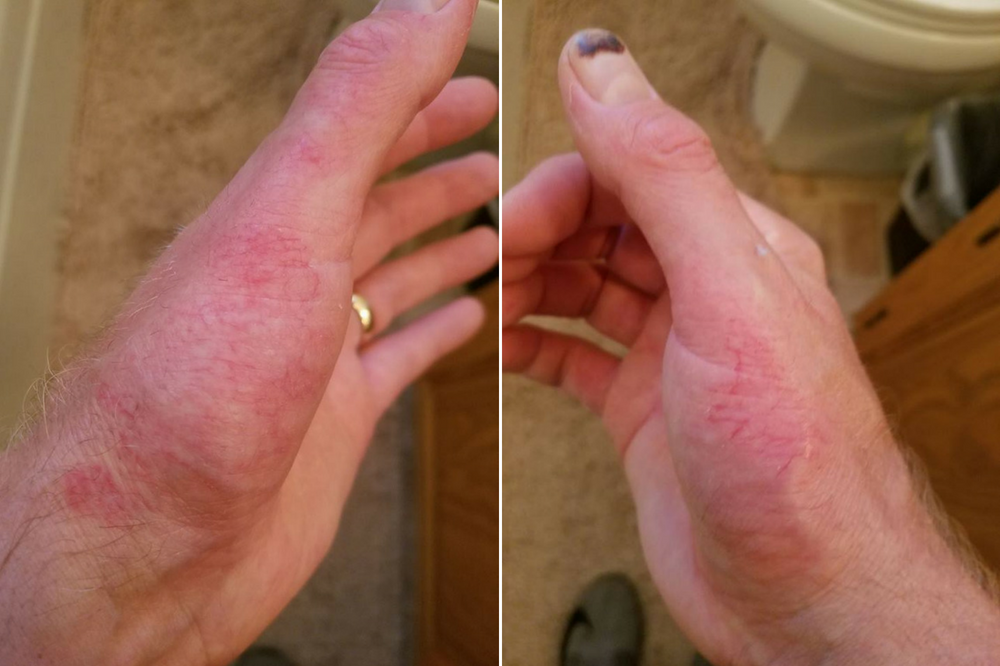 man's hands with red skin irritations