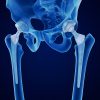 Hip replacement implant x-ray.