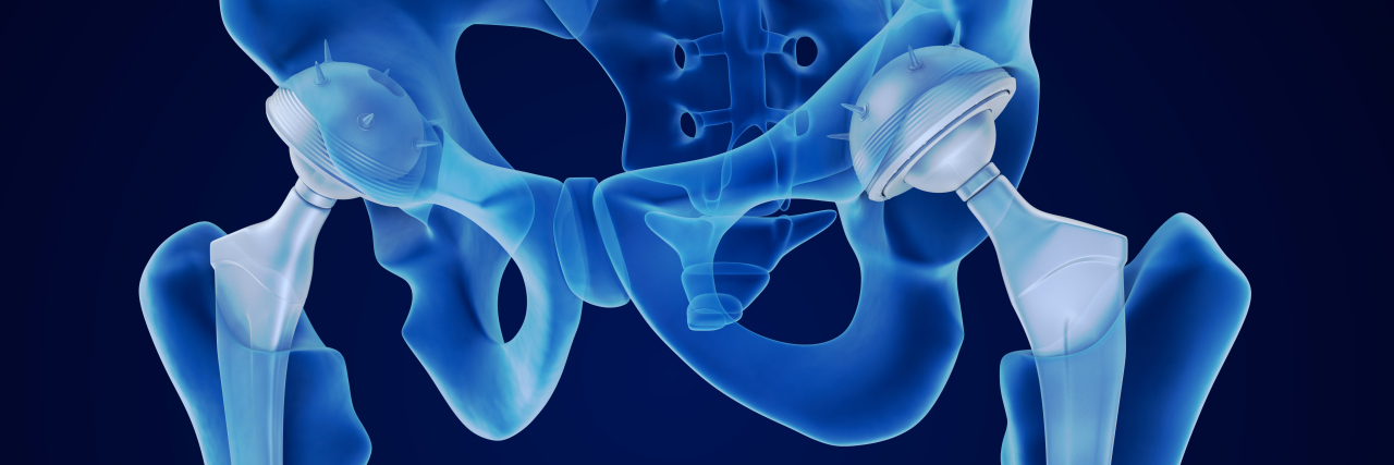 Hip replacement implant x-ray.