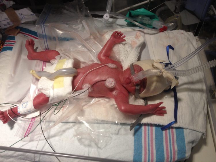 Preemie baby laying in Ziplog bag, tongue sticking out, covered in wires and machines to keep him alive