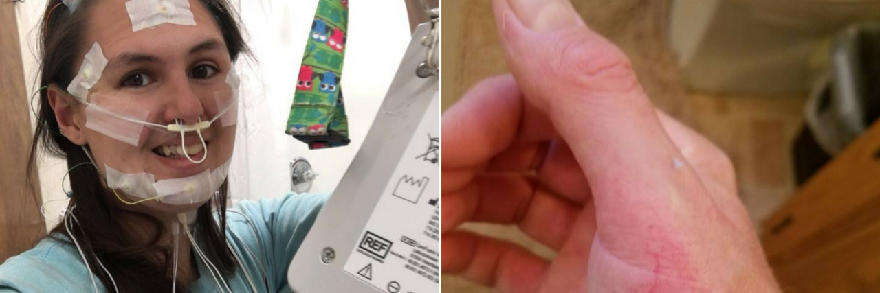 17 Side Effects of Fibromyalgia We Don't Talk About – in Photos woman wearing wires for a sleep study, and a rash on a man's hand