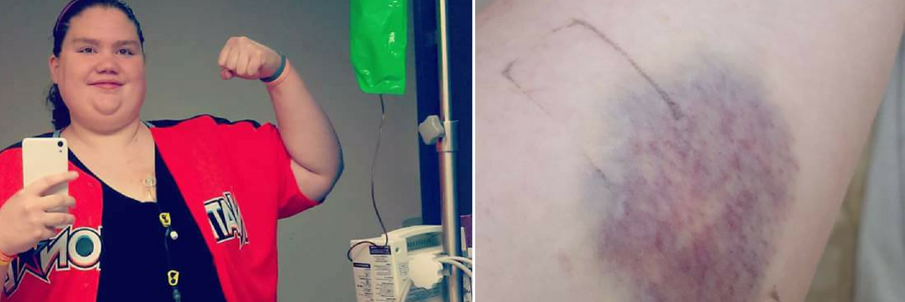 20 Side Effects of Autoimmune Disease We Don't Talk About – in Photos woman taking a selfie in a mirror next to her IV stand and flexing her bicep, and a large bruise