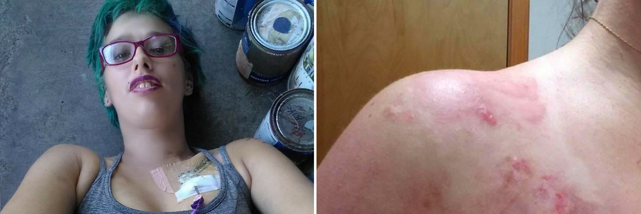18 Photos That Show How Summer Can Affect Chronic Illness Symptoms woman lying on the ground, and a rash on a woman's shoulder