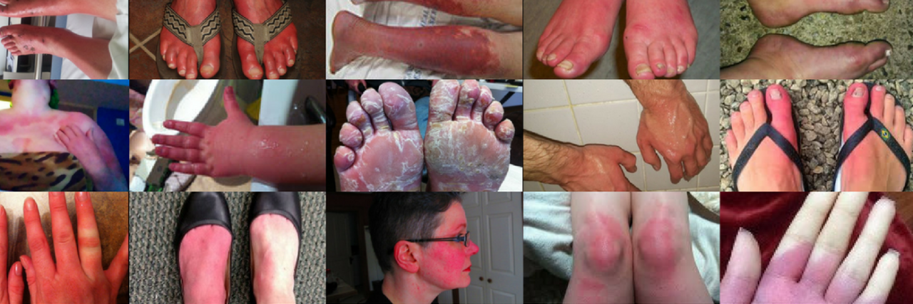 Ways People Describe What It's Like to Live With Erythromelalgia 21 Ways People Describe What It's Like to Live With Erythromelalgia