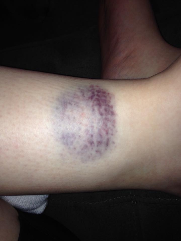 large bruise on a woman's arm