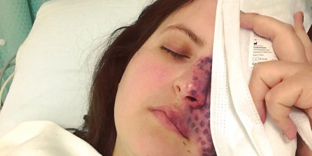 A picture of the writer holding an icepack to her head after a laser treatment, as she sits in a hospital bed.
