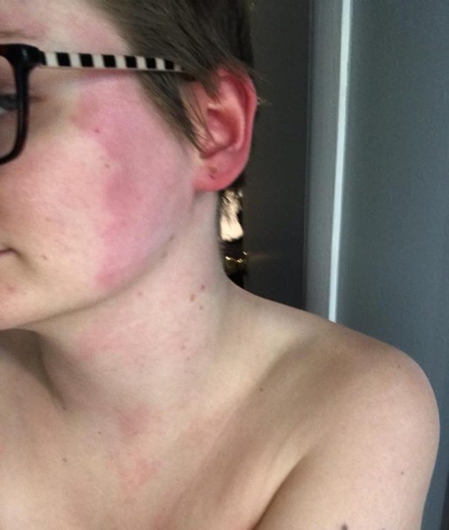 woman with red rash on half her face