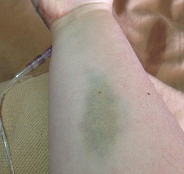 bruise on forearm