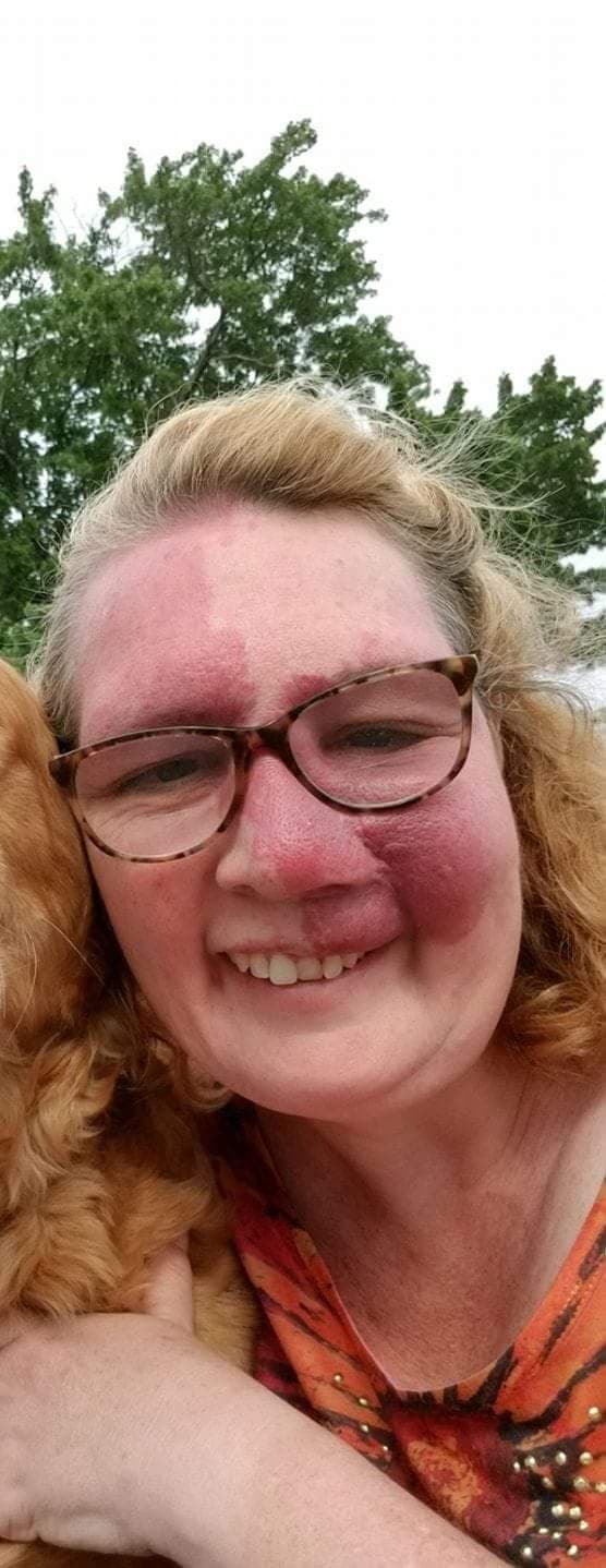 A picture of a woman with a port wine stain birthmark on her forehead and cheek.