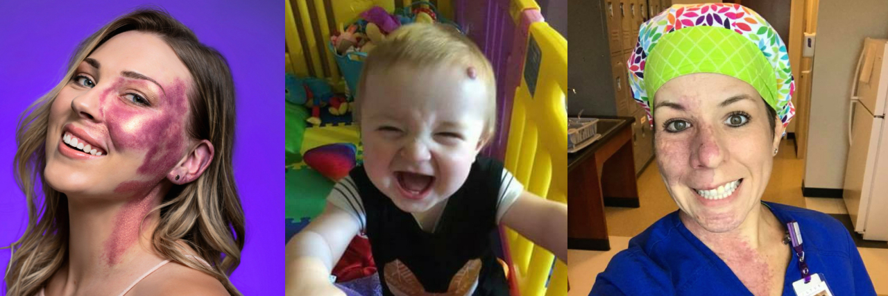 20 People Who Prove Just How Beautiful Birthmarks Are A collage of three images featuring thre people with birthmarks.