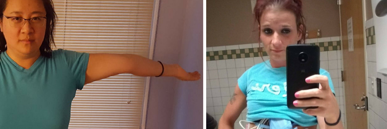 13 Symptoms of Ehlers-Danlos Syndrome in Photos woman showing hyperextended arm and woman showing electrodes on abdomen