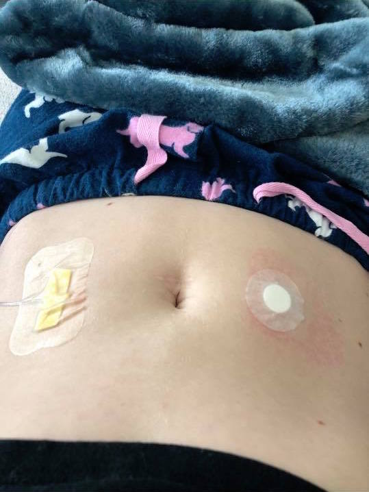 woman's stomach with bandaids on it