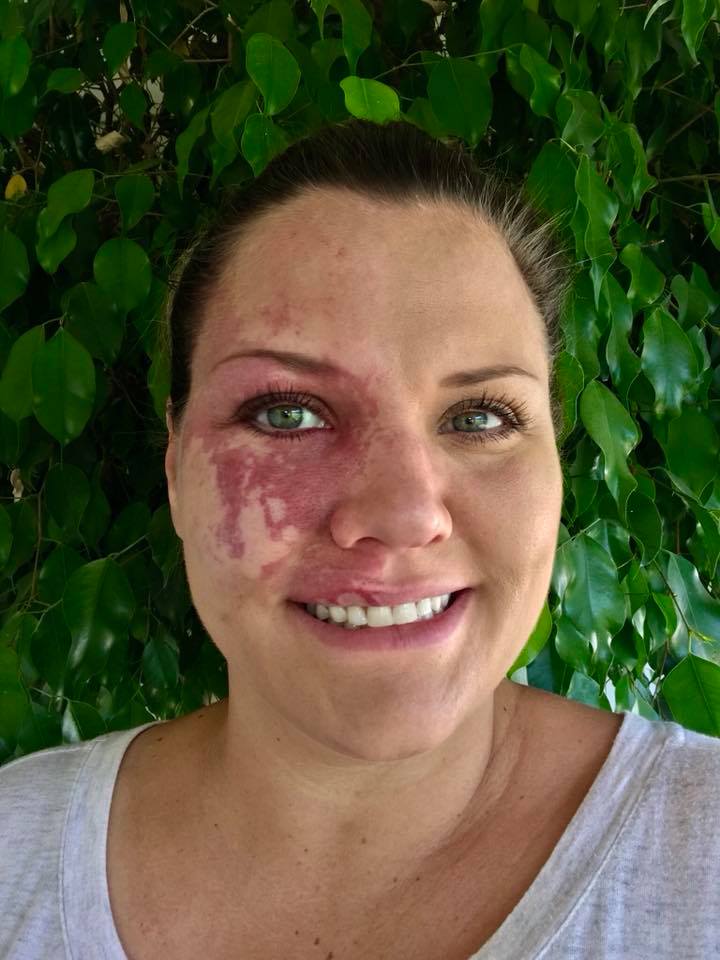 A picture of a woman with a birthmark on her cheek.