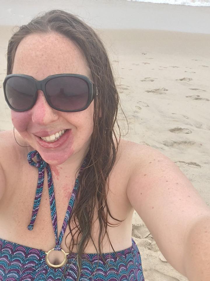 A picture of Sarah at the beach, showing her port wine stain birthmark on her face.