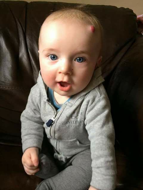 A picture of a baby boy with a hemangioma on his head.