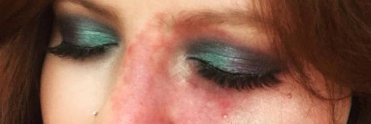 When a Stranger Yelled at Me in San Francisco Because of My Birthmark A picture of the writer.