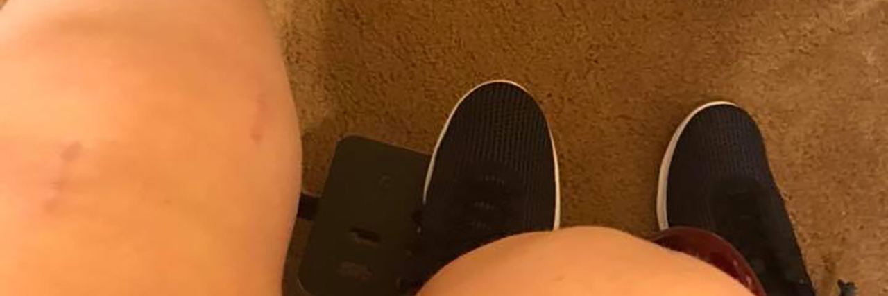 Finding Beauty in My Scars From Cerebral Palsy Surgery Alyssa's legs with surgery scars visible.