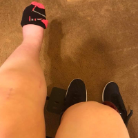 Alyssa's legs with surgery scars visible.