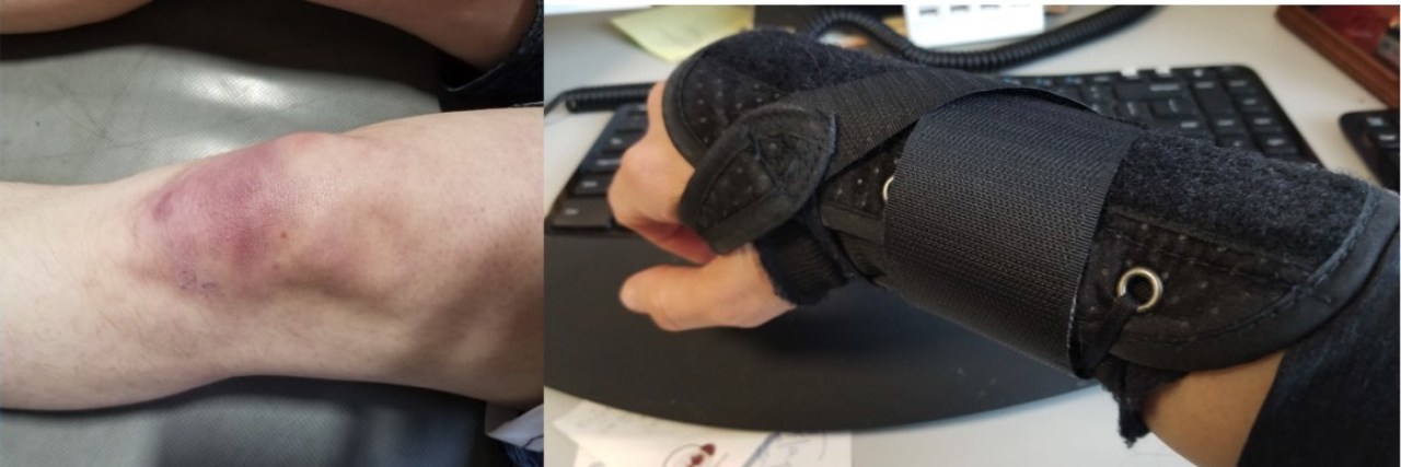 When My Invisible Pain Becomes Somewhat Visible A picture collage of the writer's body parts showing bruises and braces.