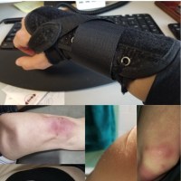 A picture collage of the writer's body parts showing bruises and braces.