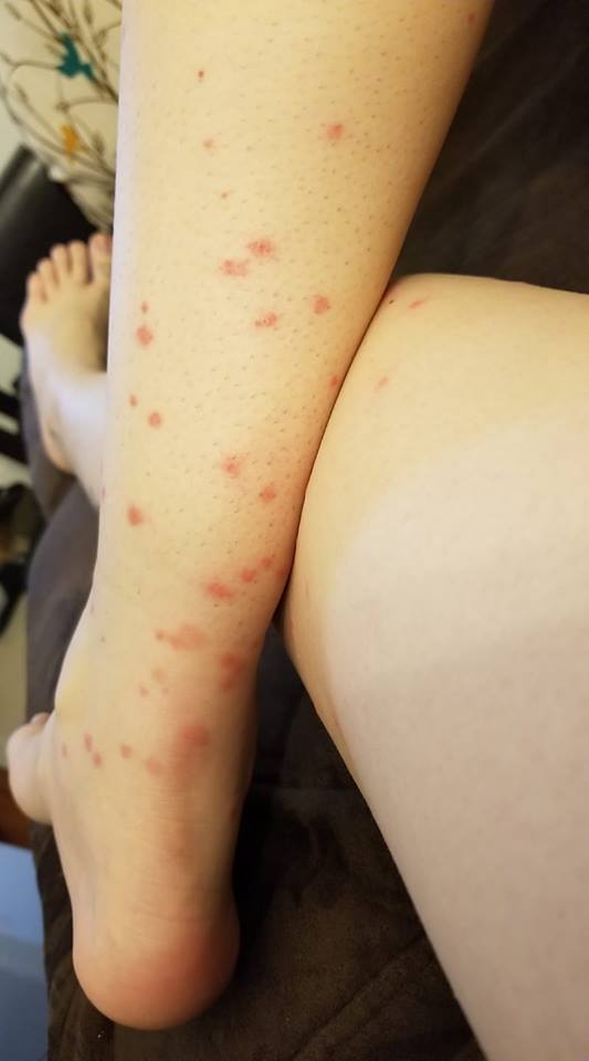bug bites all over a woman's leg