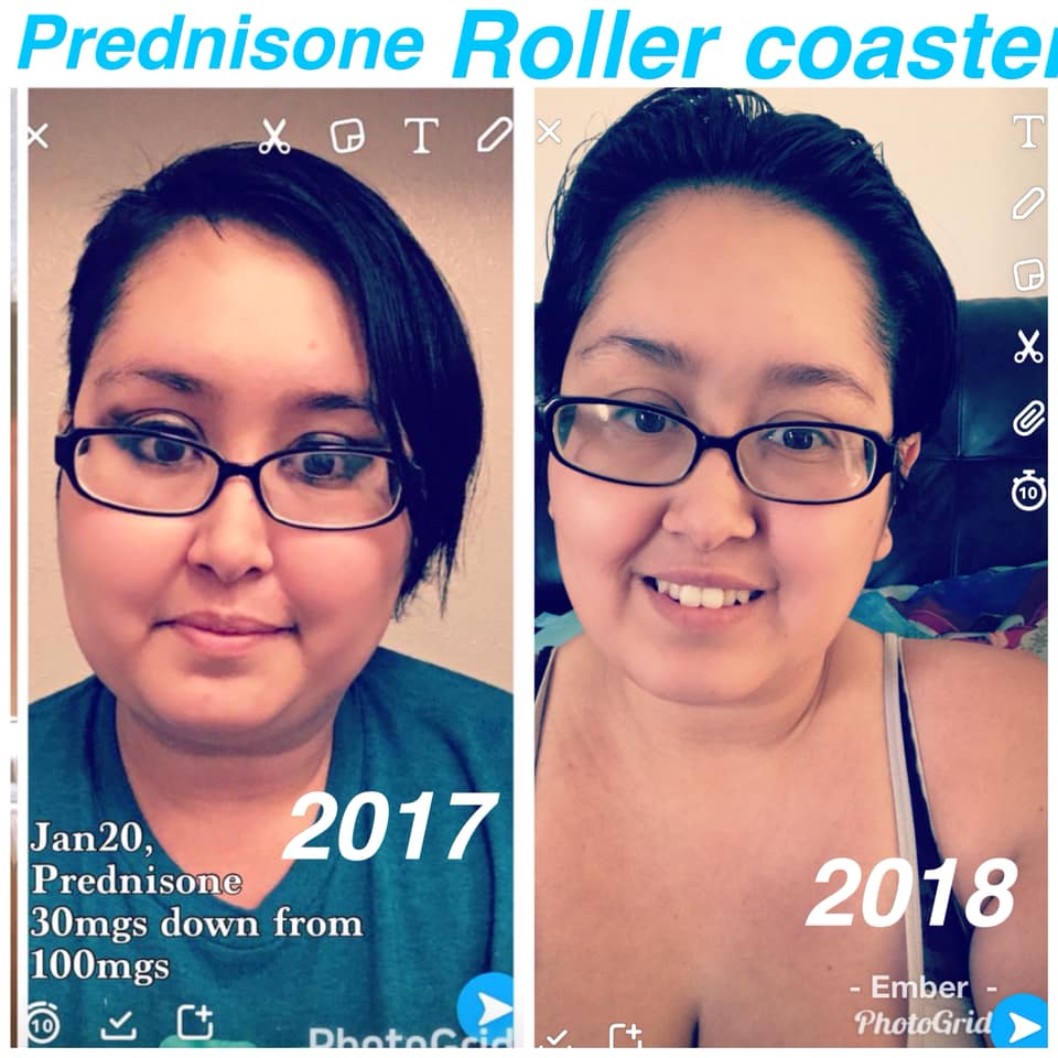 photos of a woman while taking prednisone