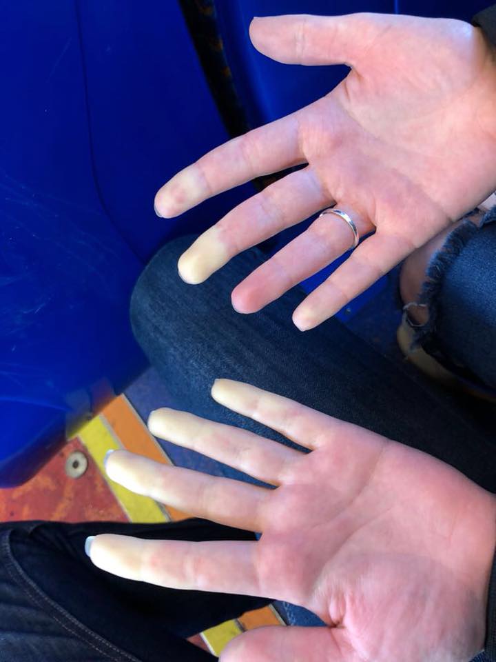 photo of a woman's hands. the tips of her fingers are white