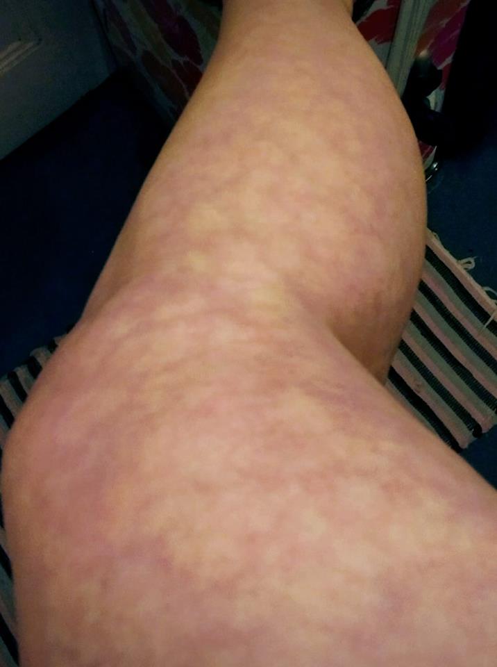 livedo reticularis rash on a woman's leg