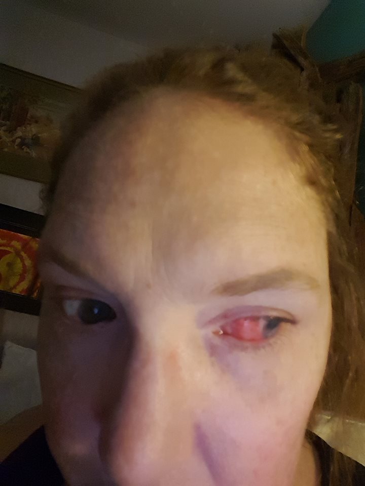 woman with red bloodshot eye due to uveitis