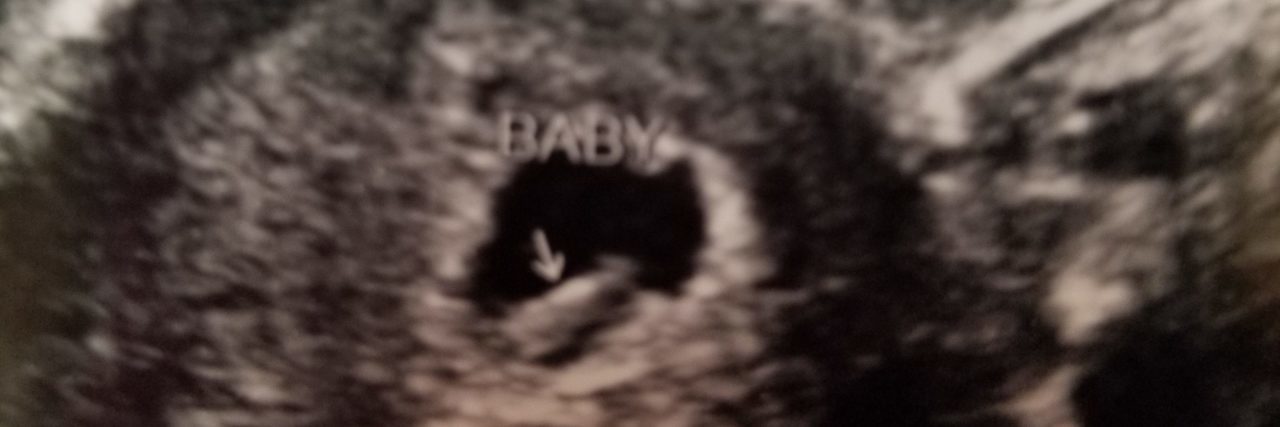 The Reality of Miscarriage in American Culture Ultrasound image