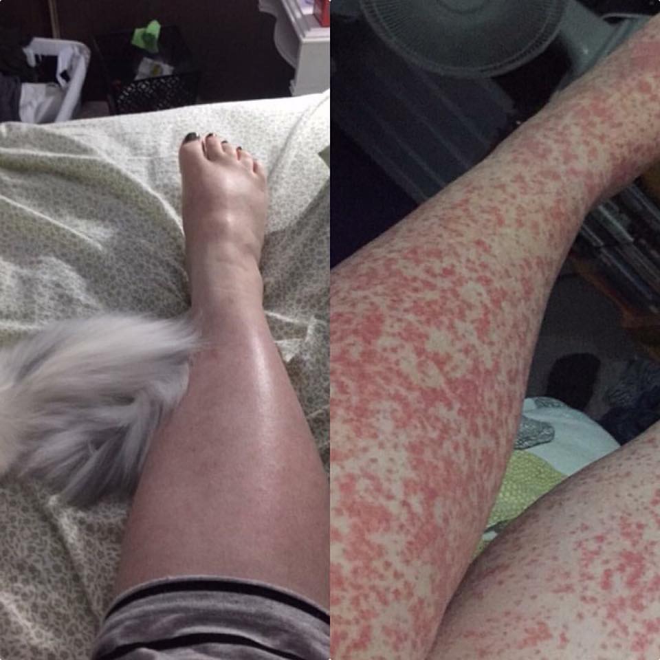 vasculitis on a woman's legs