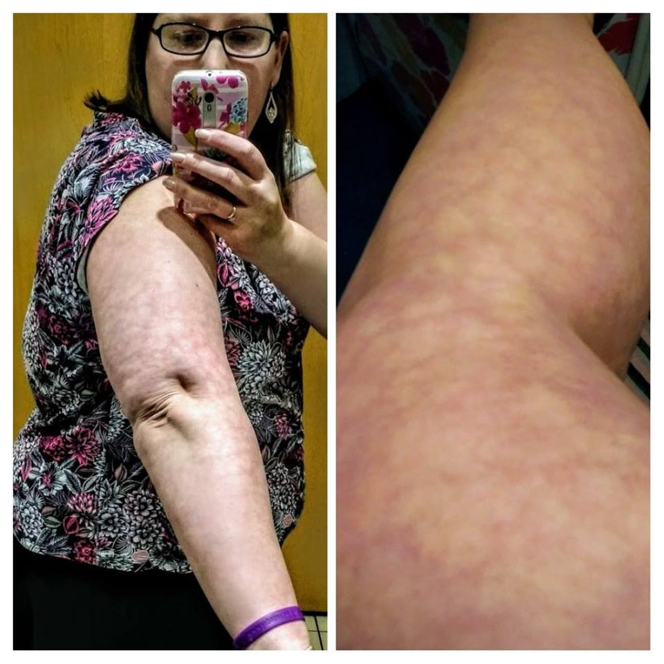 livedo reticularis rash on woman's arm