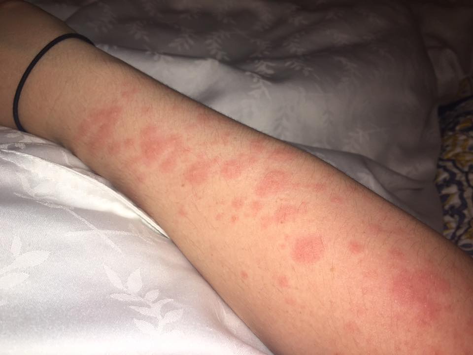 rash on a woman's arm