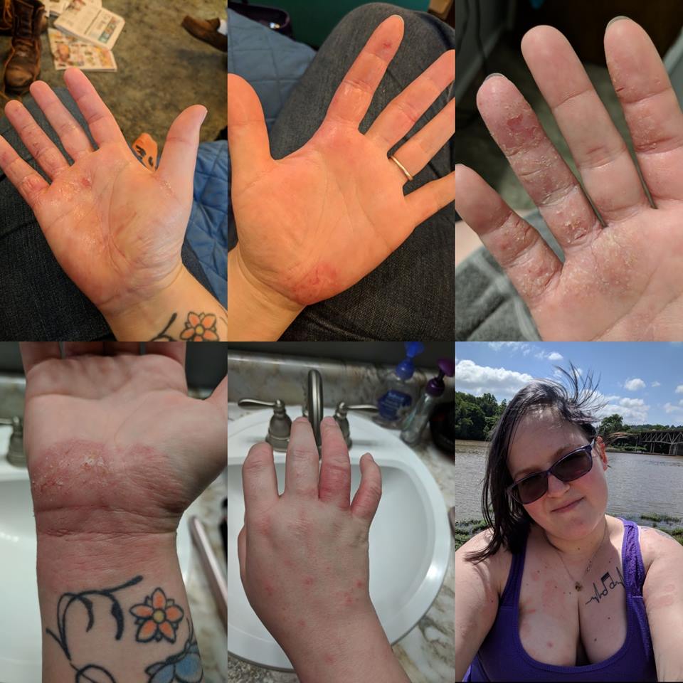 eczema on woman's hands