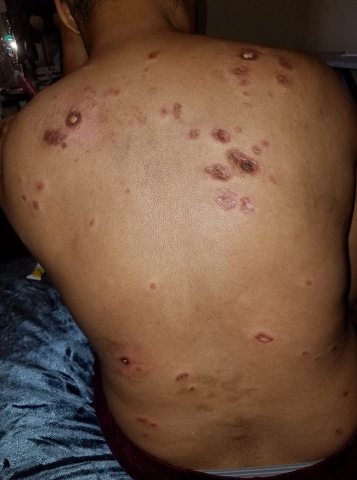 lesions on a woman's back