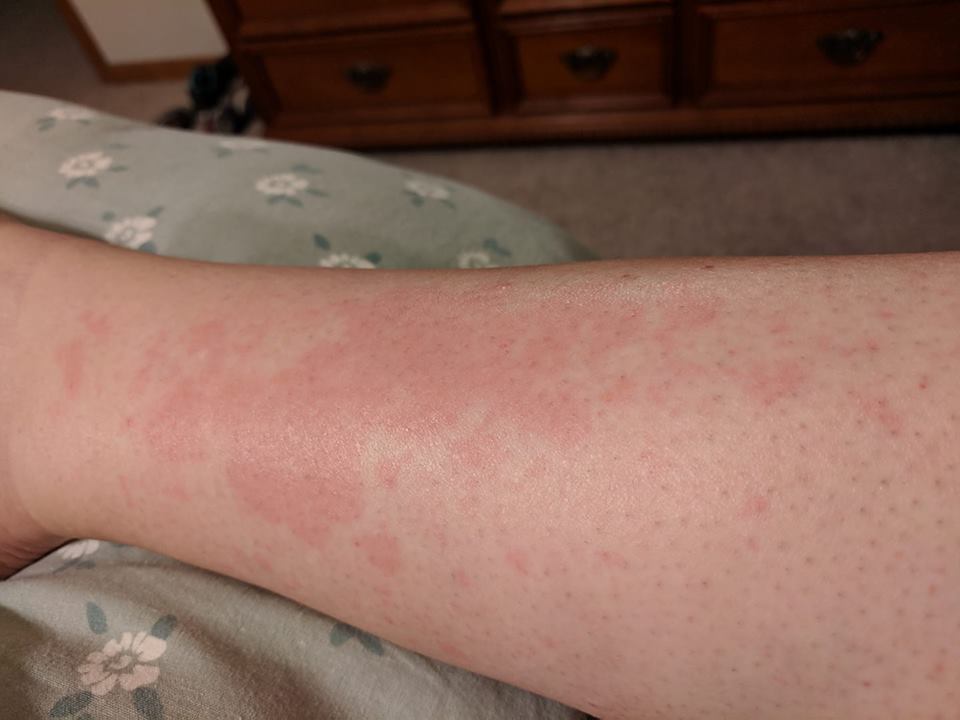 dermatomyositis rash on woman's leg
