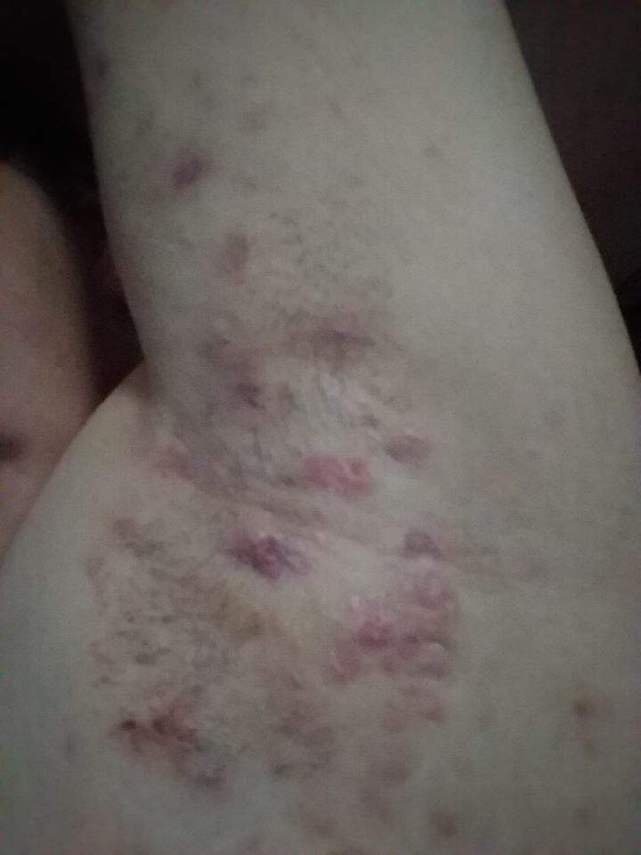 hidradenitis suppurativa in a woman's armpit
