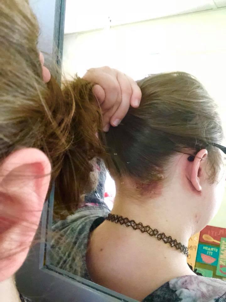 psoriasis on a woman's scalp and ear