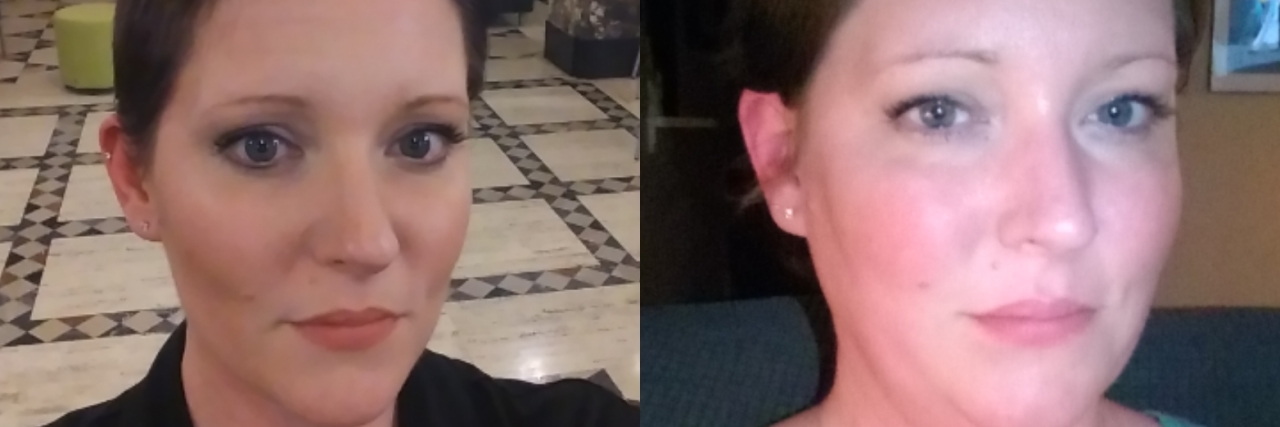side by side photos of a woman before and after taking prednisone