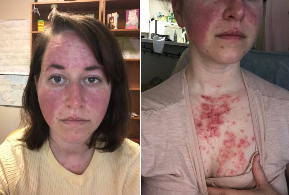 woman with a rash on her face and chest