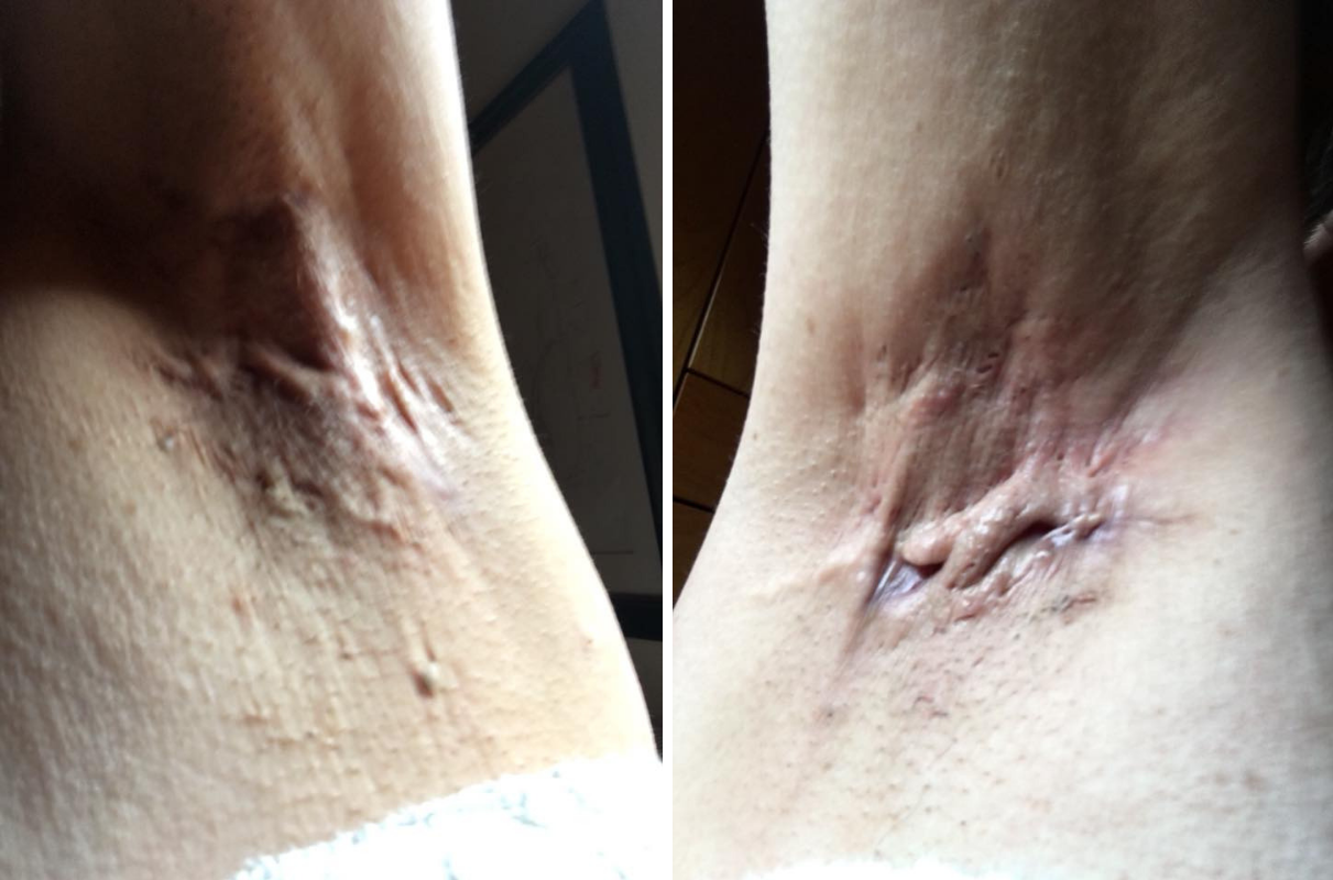 hidradenitis suppurativa in a woman's armpits