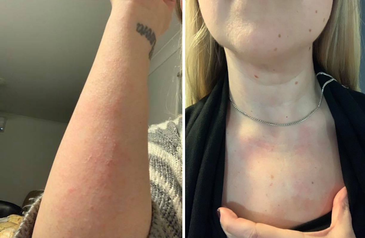 rashes on a woman's chest from fibromyalgia