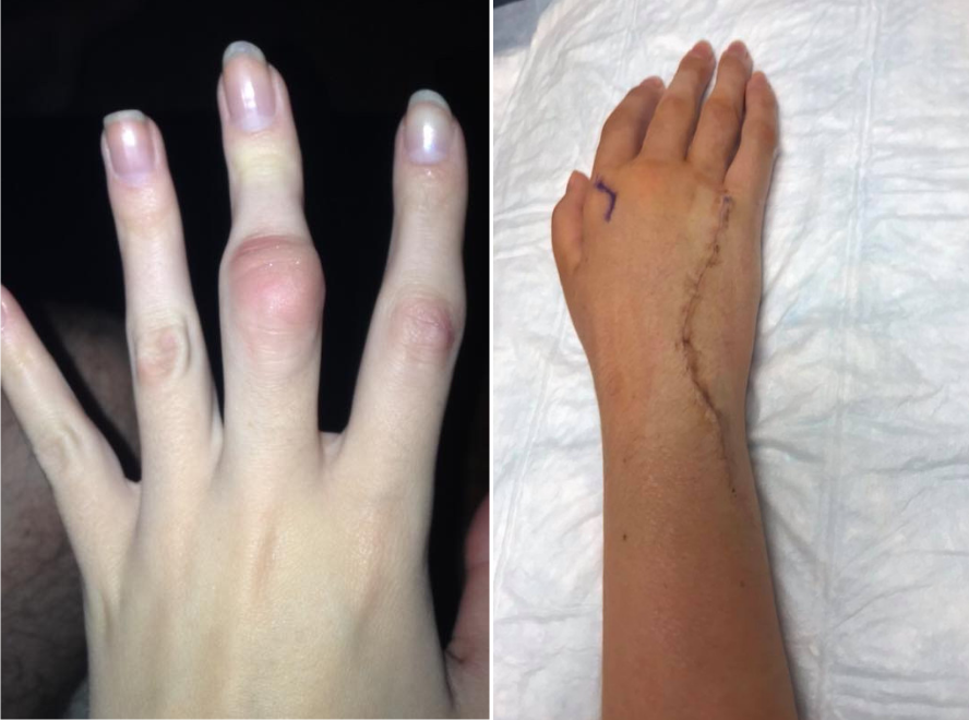 woman's hands with scars and swollen knuckles