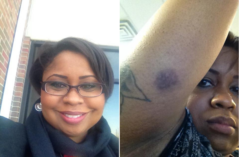 left photo: woman with moon face. right photo: woman with bruise on her right arm
