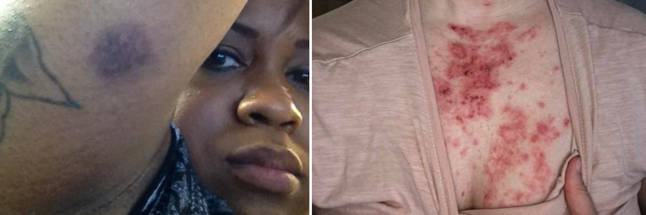 23 Photos of the 'Embarrassing' Symptoms of Autoimmune Disease left photo: woman showing a bruise on her arm. right photo: red rash on a woman's chest
