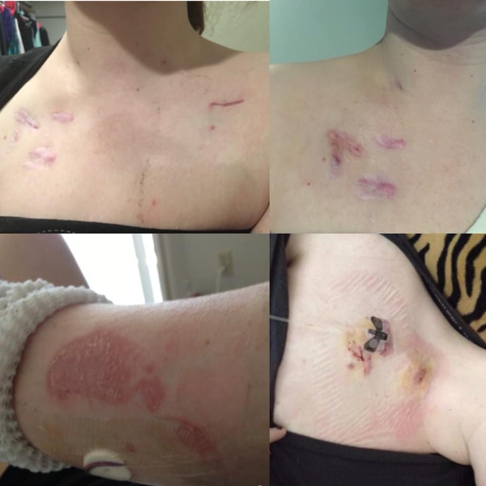 scars and adhesions on a woman's skin